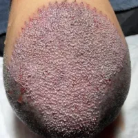 جشنواره پاییزه کاشت مو و کاشت ابرو|خدمات آرایشگری و زیبایی|تهران, دردشت|دیوار