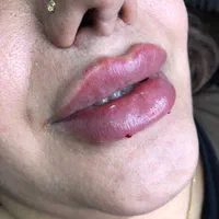 خدمات ژل و بوتاکس|خدمات آرایشگری و زیبایی|ساری, |دیوار