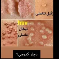 بهبود زگیل تناسلی....