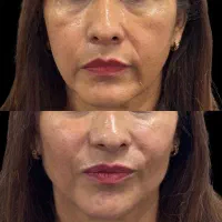 تزریق چربی جوانساز|خدمات آرایشگری و زیبایی|رفسنجان, |دیوار