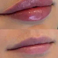 مدل جهت ژل وبوتاکس وانزیم