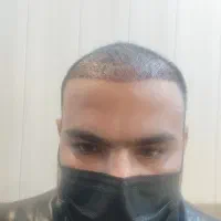 کشت مو ب روش fit|خدمات آرایشگری و زیبایی|کرمان, |دیوار