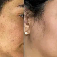 محصولات بیوممتیک وچاقی صورت،لیفت بینی