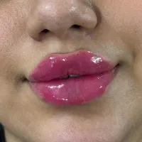 تزریق ژل لب روسی /فول فیس/شقیقه/بوتاکس، آنزیم|خدمات آرایشگری و زیبایی|تهران, فلاح|دیوار