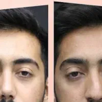 پاکسازی چربی،جوش و تیرگی پوست آقایان کاملاً تضمینی