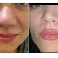 کوچک شدن بینی تضمینی فقط با ۵ میلیون|خدمات آرایشگری و زیبایی|تهران, هاشمی|دیوار