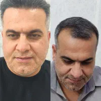 کاشت مو طبیعی  به روش sut