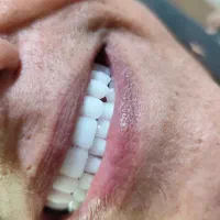 دندان مصنوعی طرح کامپوزیت و لمینت هر فک ۵ تومان|خدمات آرایشگری و زیبایی|کرج, کمالشهر|دیوار