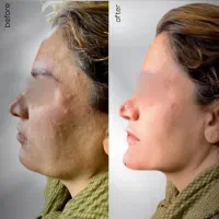 اف ویژه تمام خدمات زیبایی و جراحی در مطب|خدمات آرایشگری و زیبایی|یاسوج, |دیوار