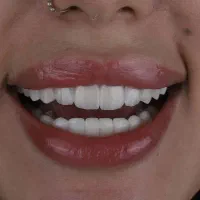 جشنواره دندانپزشکی با اقساط ویژه|خدمات آرایشگری و زیبایی|قم, شهرک فاطمیه|دیوار