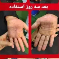 کرم درمان پسوریازیس و اگزما|آرایشی، بهداشتی، درمانی|تهران, حسین‌آباد|دیوار