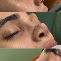 عمل بینی فقط فقط ۲۰ملیون در اهواز