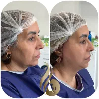 ۵۰ درصد تخفیف عمل‌های جراحی زیبایی