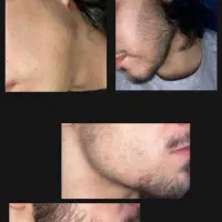 رویش تار جدید ریشات