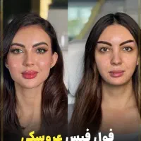 کلینیک زیبایی ژل لب روسی فیلر زاویه مزوبوتاکس لیزر