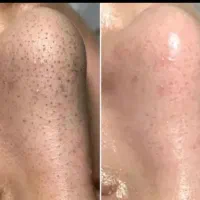 فیشیال و پاکسازی مخصوص خانمها و آقایون|خدمات آرایشگری و زیبایی|میبد, |دیوار