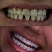 کامپوزیت دندان به مناسبت ۴ ساله شدنمون از واحدی۶۰۰