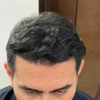 کاشت مو تخصصی|خدمات آرایشگری و زیبایی|تبریز, |دیوار