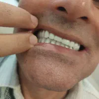 دندان مصنوعی  ( تمام چک )|آرایشی، بهداشتی، درمانی|پارس‌آباد, |دیوار