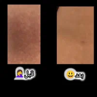 درمان قطعی لکه های پوستی