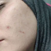 برداشتن انواع زگیل، خال و لک پوستی،فیشیال در منزل|خدمات آرایشگری و زیبایی|تهران, ظفر|دیوار