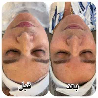 تخفیف ویژه  پاکسازی تخصصی پوست و خدمات مو