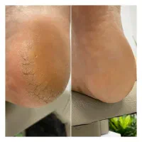 پدیکور درمانی و ریلکسی|خدمات آرایشگری و زیبایی|قائم‌شهر, |دیوار