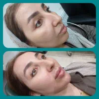 ژل ۸۰۰بوتاکس ۷۰۰ فول فیس ۵۸۰۰ لیفت صورت ۹۰۰