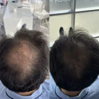 پی آر پی وسلول بنیادی/معجزه ریزش مو وجوانسازی پوست