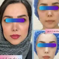 فیلر و بوتاکس و عمل های زیبایی