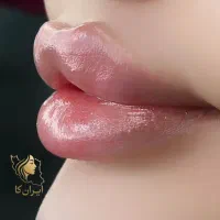 آفر ویژه تزریق فیلر و مزو|خدمات آرایشگری و زیبایی|تهران, تهرانپارس جنوبی|دیوار