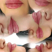 تزریق ژل فیلر بوتاکس مزوژل مزوتراپی مزو مو|خدمات آرایشگری و زیبایی|فولادشهر, C4|دیوار