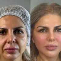 جشنواره ژل و بوتاکس بلفارو ساکشن توسط پزشک