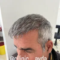 کاشت مو ۱۳ ملیون