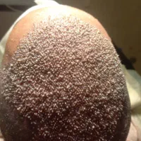 کاشت مو فول تراکم شیرازی