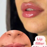 تزریق فیلر ژل/بوتاکس/prp پوست مو/پی آر‌پی/مزوتراپی|خدمات آرایشگری و زیبایی|کرج, گوهردشت|دیوار