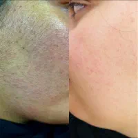 اصلاح درماپلنینگ