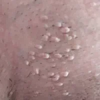رفع ریشه ای زگیل و تبخال تناسلی
