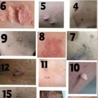 حذف وریشه کن شدن زگیل تناسلی بامحلول گیاهی