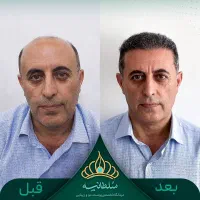 کاشت مو، بازگشت جذابیت
