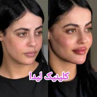جشنواره یلدایی ژل لب فیلر890بوتاکس690 پزشک متخصص|خدمات آرایشگری و زیبایی|مشهد, سجاد شهر|دیوار