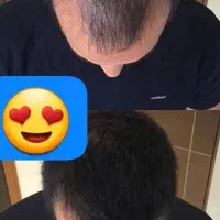 تقویت و رویش مجدد مو|آرایشی، بهداشتی، درمانی|قائن, |دیوار