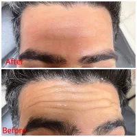 تزریق بوتاکس و فیلرتخصصی برطرف کردن انواع لک واکنه