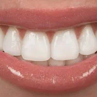 کامپوزیت بدون تراش دندان فکی ۶میلیون