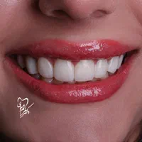 لمینت کامپوزیت ایمپلنت ارتودنسی عصب کشی|خدمات آرایشگری و زیبایی|شیراز, قصرالدشت|دیوار
