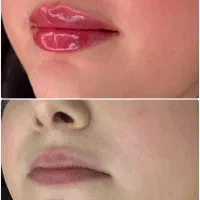 تزریق ژل لب بوتاکس مزو نخ آنزیم لیفت پکیج۱۰ سی سی