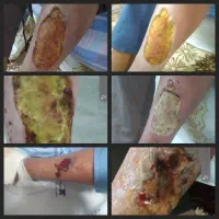 کارشناس زخم و استومی و وکیوم تراپی