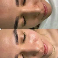 فیشیال ویژه با تخفیف محدود