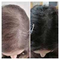 اسکالپ تخصصی در کلینیک پوست مو کاشت میکرو اسکالپ|خدمات آرایشگری و زیبایی|مشهد, شهید فرامرز عباسی|دیوار