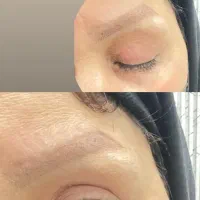 بلفارو پلاستی و لیپو غبغب